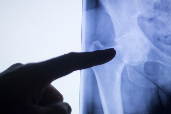 hip impingement