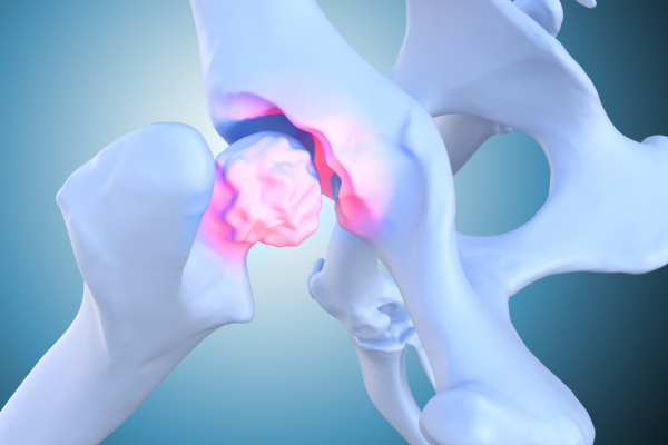joint reconstruction