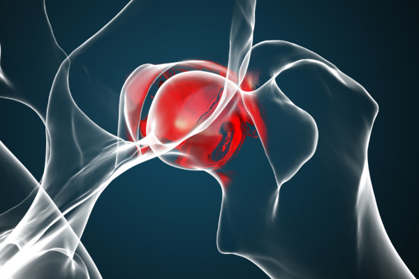 joint replacement
