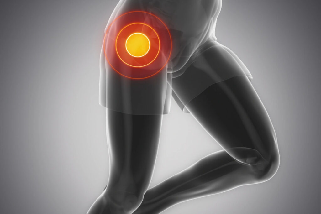 most common reason for revision hip arthroscopy