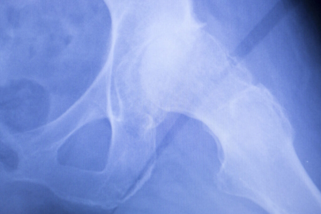 what is capsular closure during hip arthroscopy