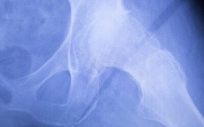 What Is Capsular Closure During Hip Arthroscopy?