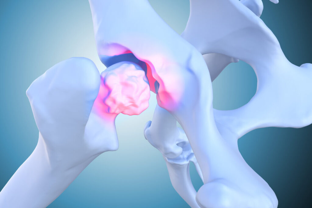 what is the success rate of hip arthroscopy