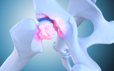 What Is the Success Rate of Hip Arthroscopy?