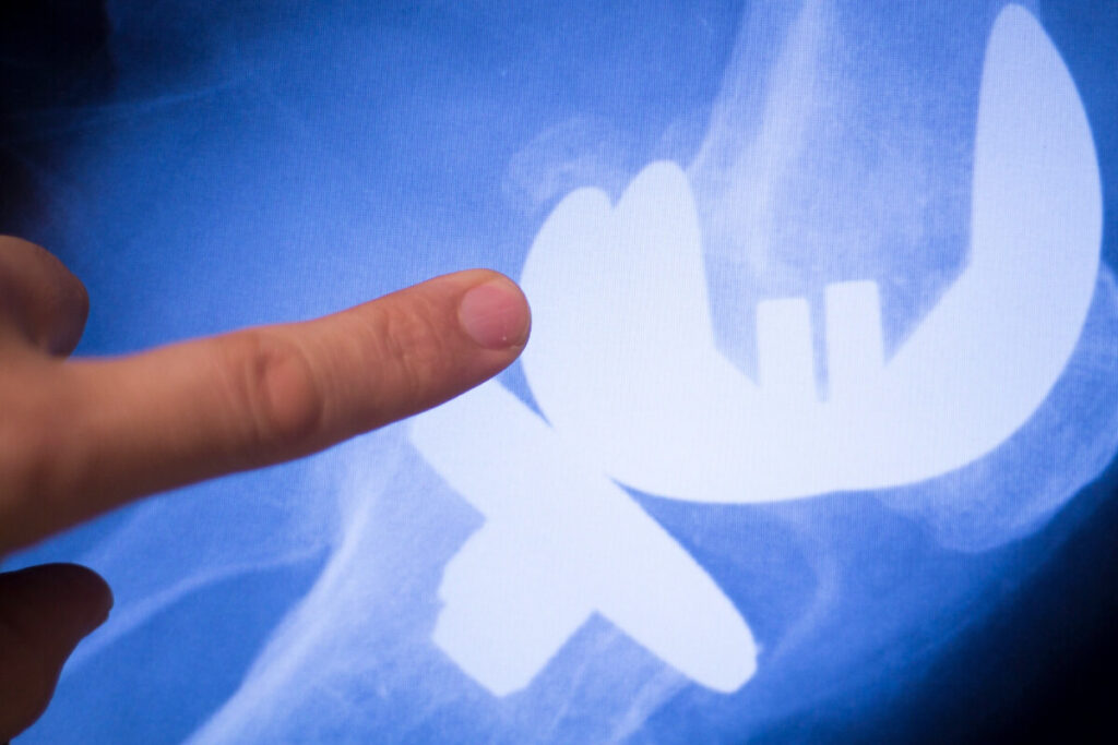 what happens if acl reconstruction fails