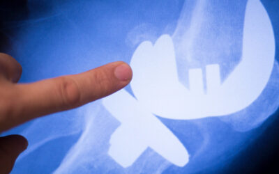 What Happens if ACL Reconstruction Fails? Causes, Symptoms, and Treatment Options