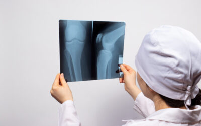 What Metal Is Used in ACL Reconstruction?