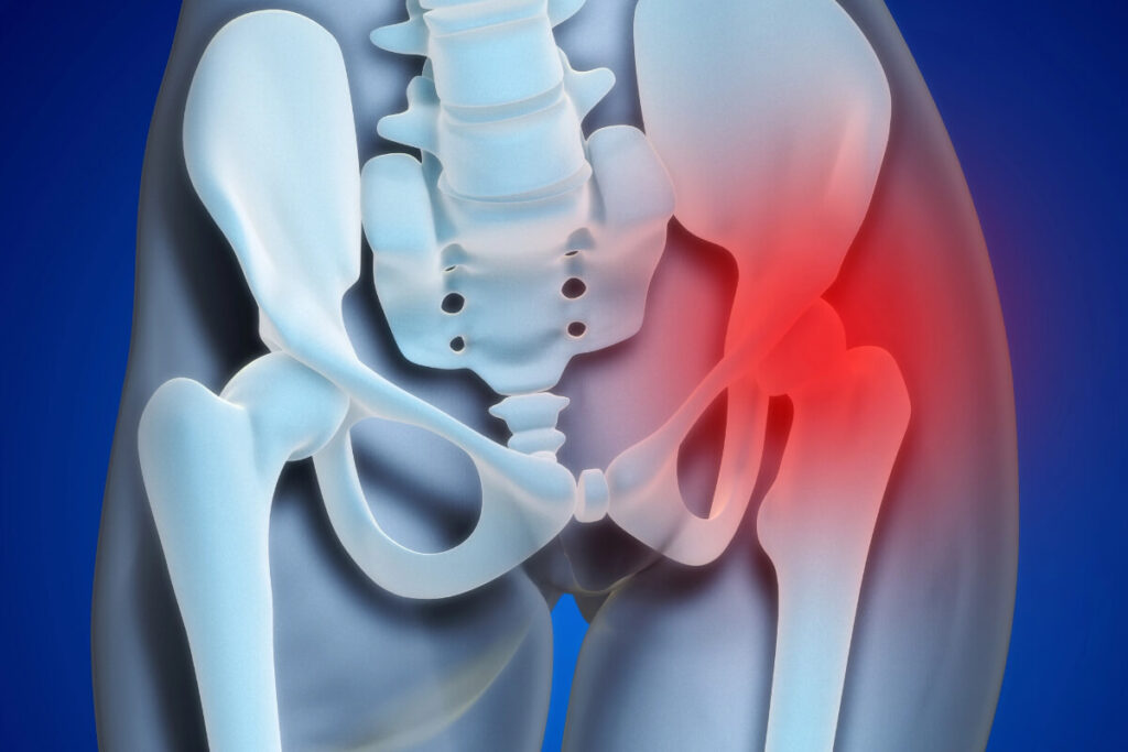 do you need surgery for hip impingement