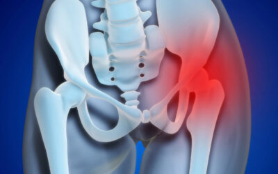 Do You Need Surgery for Hip Impingement?