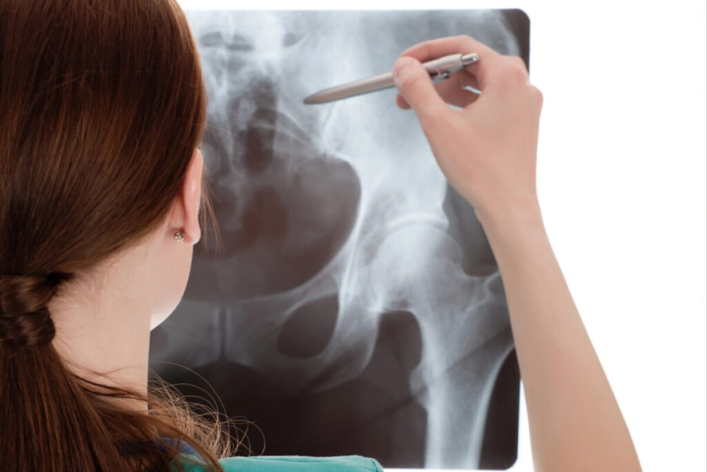 how to know if you have hip impingement