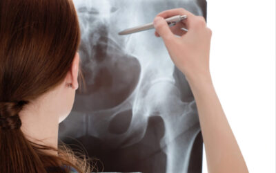 How to Know If You Have Hip Impingement?