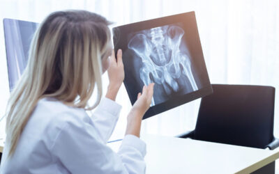 What Are the Two Types of Hip Impingement?
