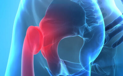 What Are the Symptoms of Hip Impingement Syndrome?