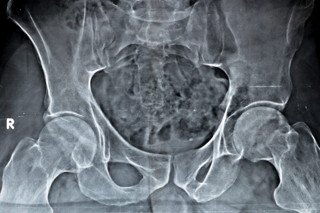 can you get hip impingement in both hips