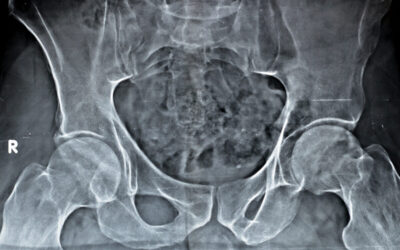 Can You Get Hip Impingement in Both Hips?